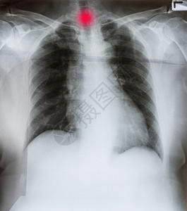 哮喘XRay人类男胸罩图像部咳嗽图片