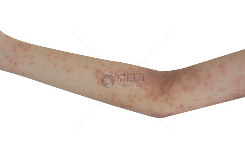 手臂上的皮肤疹分离出一个白色背景保健概念敏感的孩子生病图片