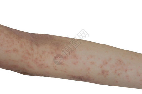 坏的手臂上皮肤疹隔离白色背景亚洲人热图片