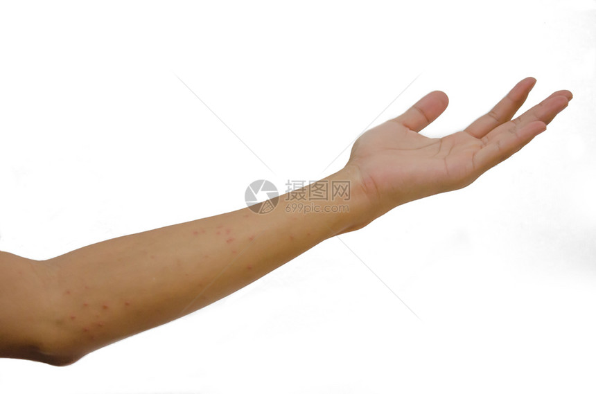 健康状况皮疹真拉西在手臂上白色背景的图片