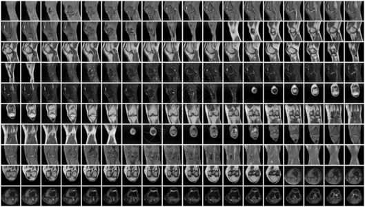 左膝的磁共振成像MRI生病的放射学线照相图片