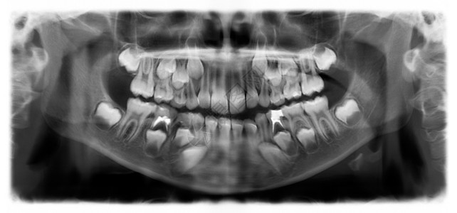 牙疼牛奶光谱射电仪是一种扫描牙科X光片对上下巴进行检查降低图片