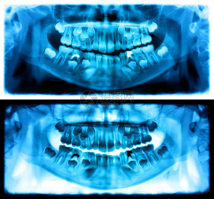 智慧全景X光片是上颌骨和下的扫描牙科光片照显示一个7岁的孩子儿童全景牙科光片龋齿基本的图片