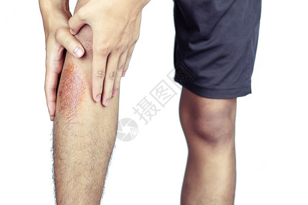 药物打扫运动造成的双腿伤员人数运动的图片