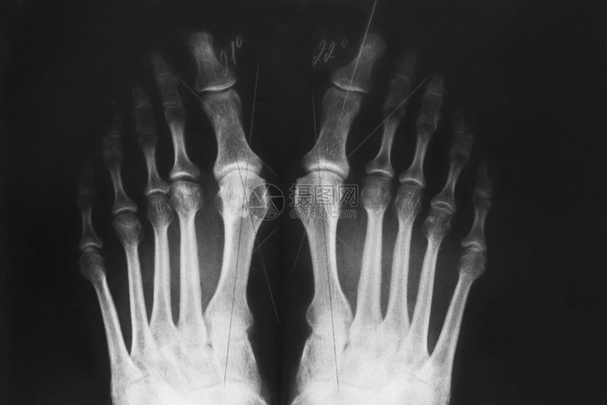 脚部X光趾或手指骨的valgus畸形三度矫疾病射线脚丫子解剖学图片
