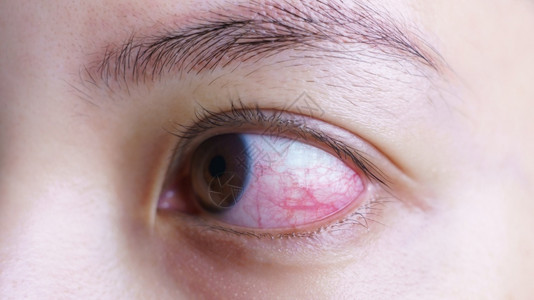 结膜炎的眼睛特写图片