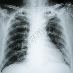 关心临床X射线辐图象Chest报告医疗诊断保健和概念成人图片