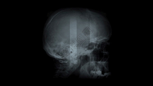 成像X射线骨3d插图黑色背景的X光面板图片