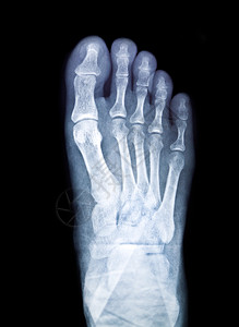 透明黑色背景的双脚X光电影考试图片