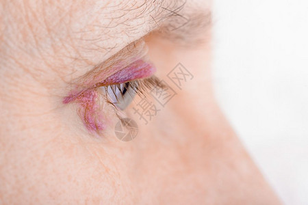 瘀斑女紫色的瓜拉纳皮由于毛细管破裂造成血肿或瘀伤而受的妇女眼部也可能是结膜炎或其他过敏眼睛炎艾滋背景