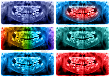 脸颚骨全景X光片是上颌骨和下的扫描牙科光片照显示一个7岁的孩子彩色图像全景牙科光片洞设计图片