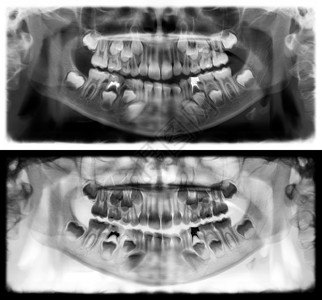 上颌骨下颌骨孩子光谱射电仪是一种扫描牙科X光片对上下巴进行检查牛奶背景