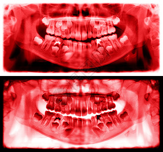 光谱射线仪是一种扫描牙科X光片对上下巴进行检查该照片显示一名7岁儿童的年龄为7岁红图象全景牙医X光片降低红色的运河图片