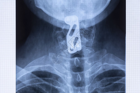 子宫颈的健康仪器表科学C5和C6脊椎损伤后用于支持子宫颈脊椎的钛板固定成像线使用脊椎仪表概念提供颈部稳定设计图片