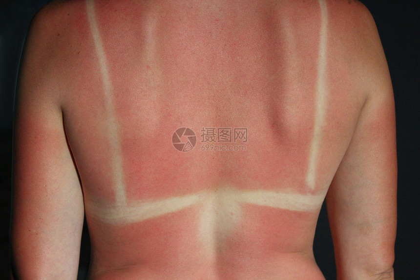 从太阳燃烧在身体上从太阳燃在女孩的背部癌症烧伤女图片