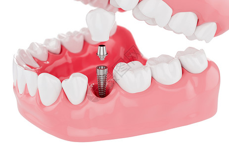 固定假牙胶白底植树牙齿保健选择焦点3D立体切除器植入物使固定设计图片