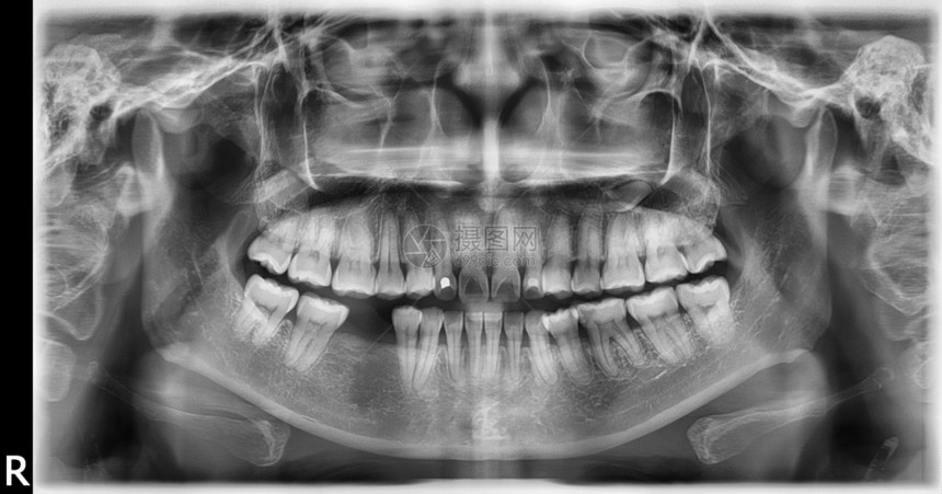 对上下巴整形矫造影仪或OPG的牙科X射线智慧颅骨口服图片
