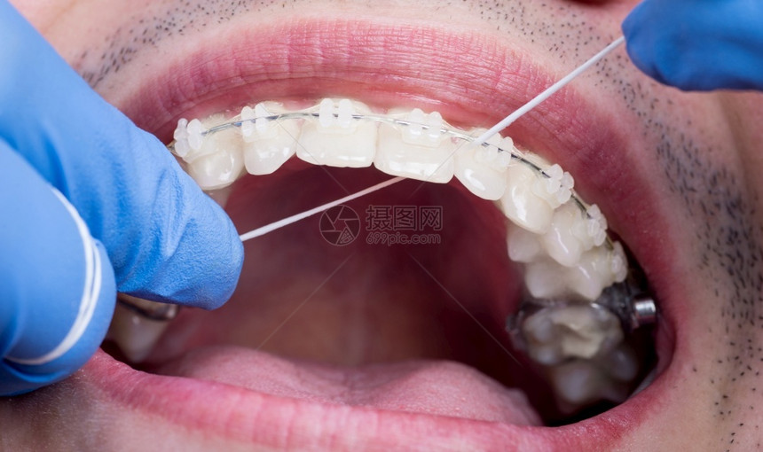 牙医用牙线给患者治疗图片