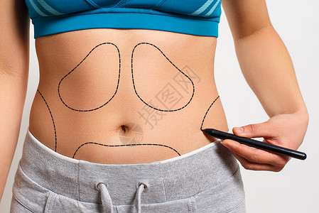 腹部手术腹部皮肤一个女人用白色背景在她身体的乳液抽取区上显示一条虚线个女人用她的体内脂液抽吸区展示一条虚线脂肪团设计图片