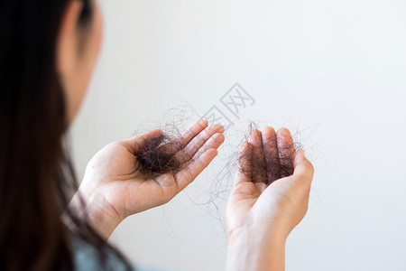 经过活的引起妇女对洗发水过敏导致的毛发损失图片