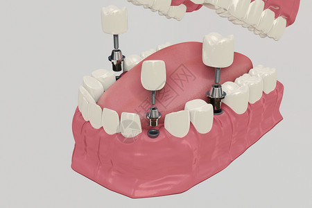 舌头舔牙齿3D假牙种植设计图片