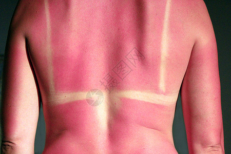 晒斑经过健康人体背部晒伤后背部被太阳光束烫伤背部晒后图片