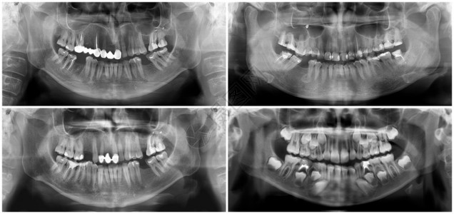放射学齿降低上颌和下全景牙科X射线数字图像30岁女4男7儿童的上颌骨和下焦平面断层扫描光片图片