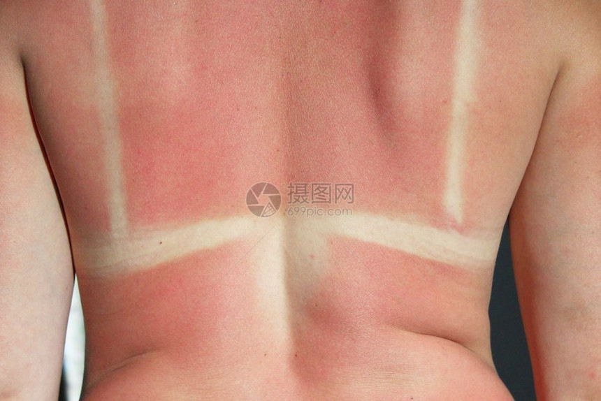 保护日晒后被烧焦太阳光束烧焦的背部曝光过度图片
