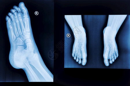 脚丫子扫描电影正常的足放射医疗诊断创伤学和矫形外科等X射线诊所设计图片