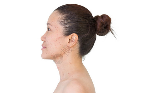 移动沙龙亚洲妇女激光治疗的面部和颈激光处理器皮肤雀斑和黑暗点产生的烧或沙巴皮肤科变色高清图片素材