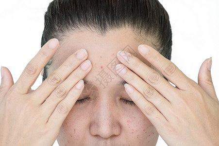 黑暗的亚洲妇女激光治疗的面部和颈激光处理器皮肤雀斑和黑暗点产生的烧或沙巴头发缺陷女士高清图片素材