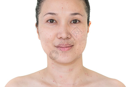 美丽的亚洲妇女激光治疗的面部和颈激光处理器皮肤雀斑和黑暗点产生的烧或沙巴衰老龙缺陷高清图片素材