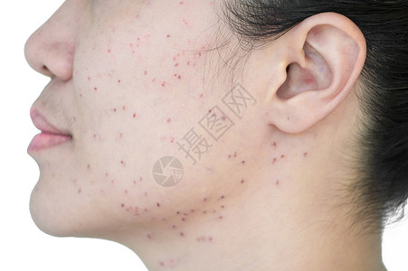 去除雀斑脸收紧亚洲妇女激光治疗的面部和颈激光处理器皮肤雀斑和黑暗点产生的烧或沙巴者背景