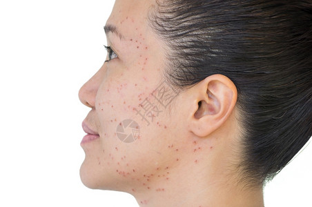 去除雀斑脖子亚洲妇女激光治疗的面部和颈激光处理器皮肤雀斑和黑暗点产生的烧或沙巴头发红色的背景
