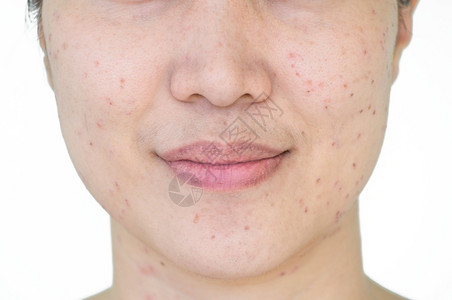 亚洲妇女激光治疗的面部和颈激光处理器皮肤雀斑和黑暗点产生的烧或沙巴亚洲人年龄医疗的裸高清图片素材