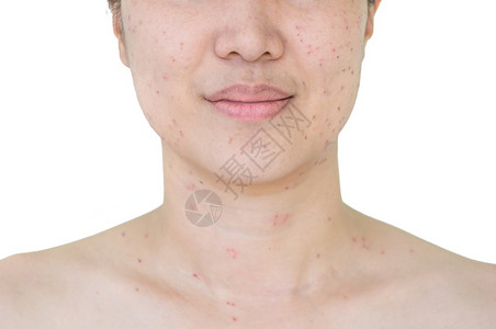 女士化妆品亚洲妇女激光治疗的面部和颈激光处理器皮肤雀斑和黑暗点产生的烧或沙巴身体高清图片素材