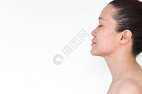 亚洲人黑暗的妇女激光治疗的面部和颈激光处理器皮肤雀斑和黑暗点产生的烧或沙巴病人面部的高清图片素材