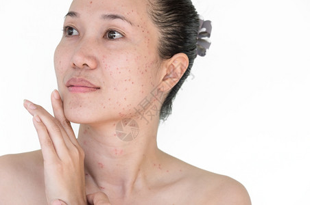 年轻到衰老或者亚洲妇女激光治疗的面部和颈激光处理器皮肤雀斑和黑暗点产生的烧或沙巴衰老年轻的背景
