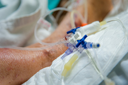 采用密集的女80s流感19do气管切除手术用呼吸机在特护病房ICU室急诊的病人床上呼吸帮助在医院进行生命概念保健病人在医院做气管背景