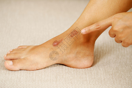 瘢痕疙瘩缝一种痛伤疤是由愈合身体的伤口过程形成而不论伤痕是因事故外科创伤或烧造成的无论疤是因痕外科口或烧所致背景