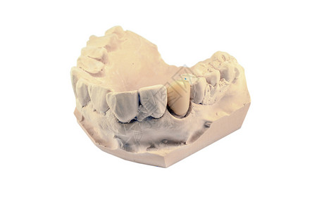 黏土替换实验室白色背景上分离的假牙石膏模型图片