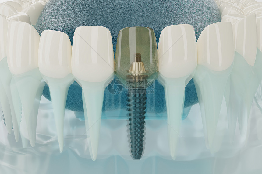 嘴半透明手术牙科植入器的密闭组件透明3D转换图片