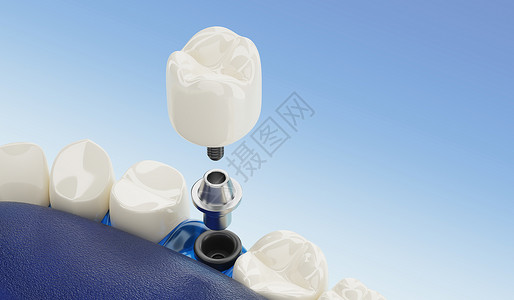 远眺玻璃桥牙齿科植入器的密闭组件透明3D转换健康零件设计图片