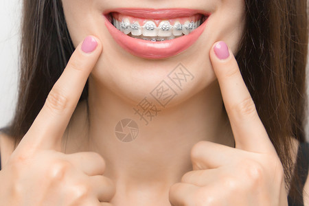 金属自锁托槽卫生快乐女嘴里的牙套美白后用两根手指在牙齿上的托槽显示自锁式托槽带有金属系和灰色松紧或橡皮筋可实现完美笑容正畸牙齿治疗快乐女嘴里背景