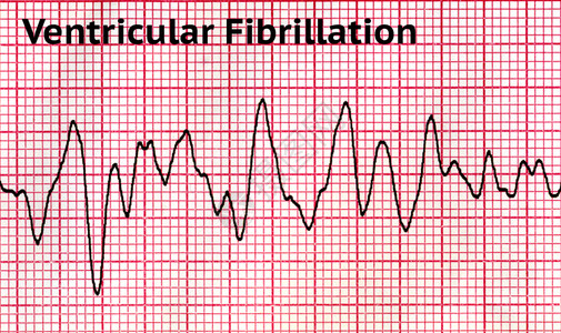 心动过速治疗心血管纤维裂变VF是一种情况在这状态中内室肌肉的脏收缩不协调使其颤动而不是正常结合只能通过心电图学证实这是一种医疗紧急情设计图片