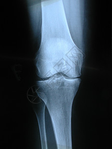 X射线疾病医生考试医疗胫骨骨头骨骼x射线腓骨身体背景图片