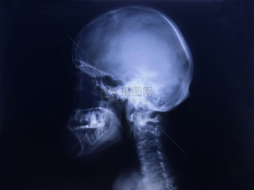 人头骨身体调查颅骨辐射x射线x光骨骼药品图片