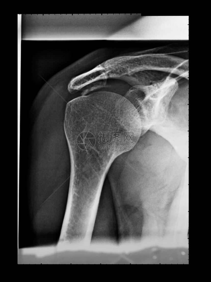 X射线骨骼肩膀医疗x光诊断射线x射线图片