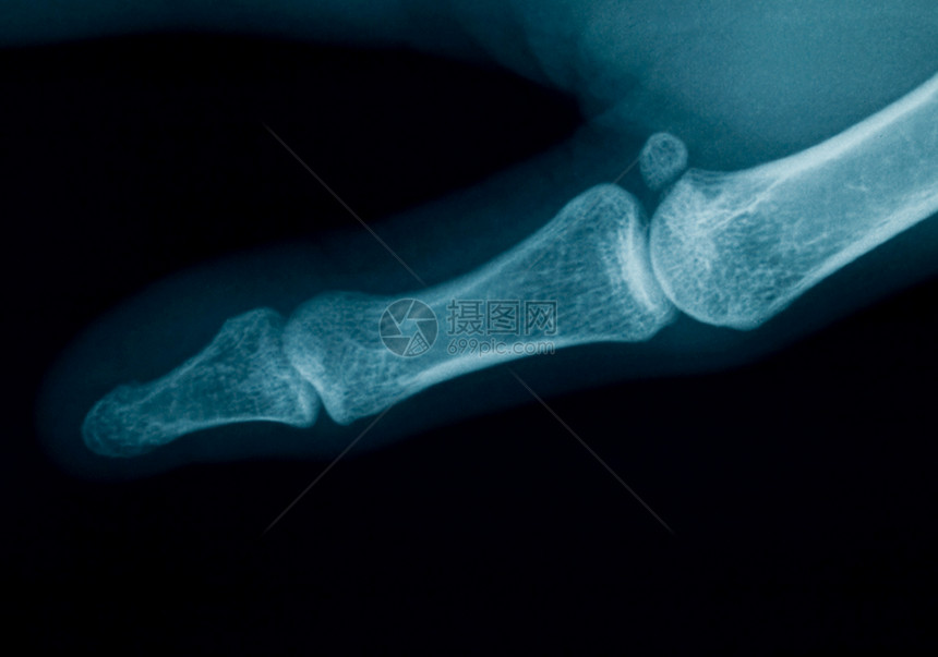 手指X射线图片
