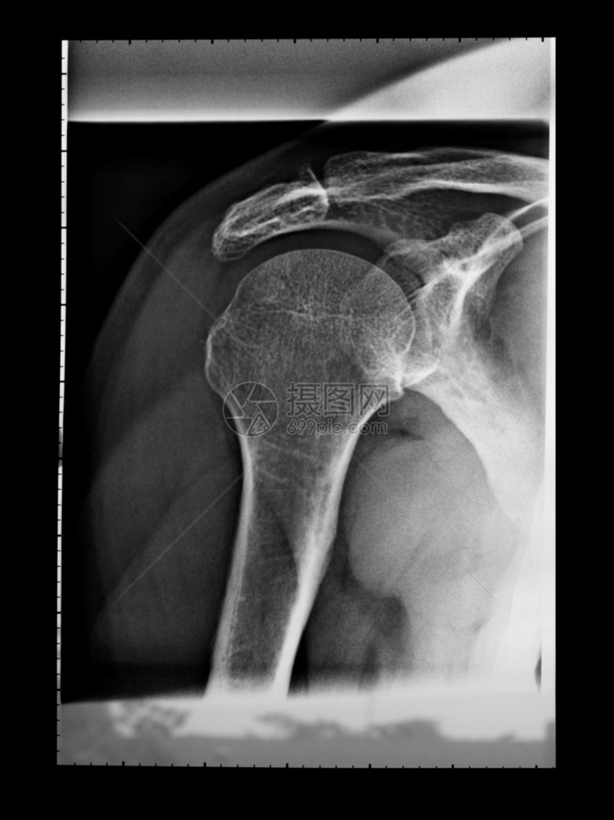 X射线医疗骨骼x光x射线诊断射线肩膀图片